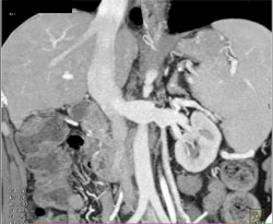 Prominent Left Gonadal Vein - CTisus CT Scan