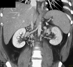 IVC Occlusion With Extensive Collaterals - CTisus CT Scan