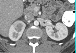 Acute Pyelonephritis - CTisus CT Scan