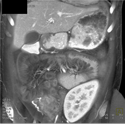 Transplant Kidney in Llq - CTisus CT Scan