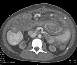 Thickened Small Bowel With End Stage Renal Disease (ESRD) and Transplant Kidney in the Left Lower Quadrant - CTisus CT Scan