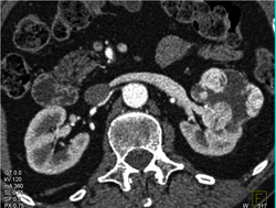 Vascular Renal Cell Carcinoma in Various Renderings and Phases - CTisus CT Scan