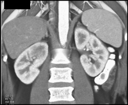 Acute Pyelonephritis - CTisus CT Scan