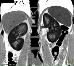 Acute Pyelonephritis - CTisus CT Scan