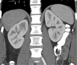 Acute Pyelonephritis - CTisus CT Scan