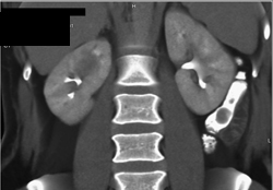 Acute Pyelonephritis - CTisus CT Scan