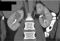 Acute Pyelonephritis - CTisus CT Scan