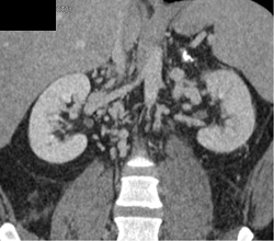 IVC Occlusion With Collaterals - CTisus CT Scan