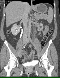 Occlusion of Left Gonadal Vein - CTisus CT Scan