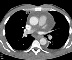 Pericardial Effusion and Acute Pyelonephritis - CTisus CT Scan