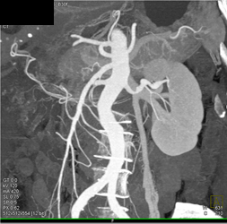 Left Gonadal Vein With Various Renderings - CTisus CT Scan