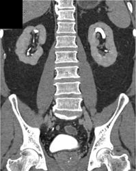 Scarring of the Kidneys - CTisus CT Scan