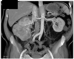 Renal Cell Carcinoma - CTisus CT Scan