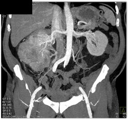 Renal Cell Carcinoma - CTisus CT Scan