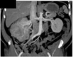 Renal Cell Carcinoma - CTisus CT Scan