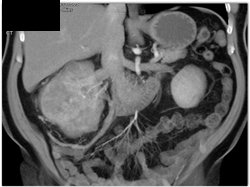 Renal Cell Carcinoma - CTisus CT Scan