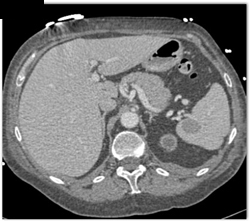 Transplant Kidney and Lymphoma - CTisus CT Scan