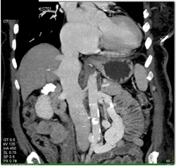 Dilated IVC and Collaterals - CTisus CT Scan