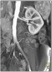 2 Left Renal Arteries - CTisus CT Scan