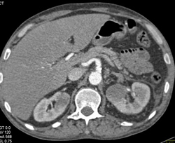 2 Left Renal Arteries - CTisus CT Scan