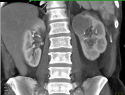 Cystic Renal Cell Carcinoma - CTisus CT Scan