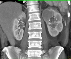 Cystic Renal Cell Carcinoma - CTisus CT Scan