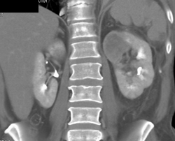 Cystic Renal Cell Carcinoma - CTisus CT Scan