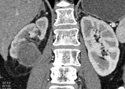 Complicated Cyst - CTisus CT Scan