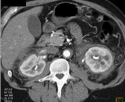 Retroperitoneal Fibrosis - CTisus CT Scan