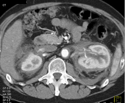 Retroperitoneal Fibrosis - CTisus CT Scan