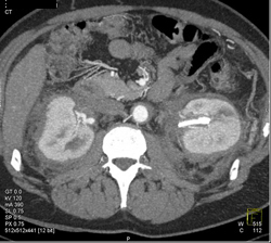 Retroperitoneal Fibrosis - CTisus CT Scan