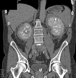 Retroperitoneal Fibrosis - CTisus CT Scan