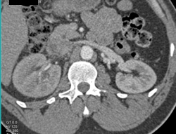 Delayed Function Right Kidney - CTisus CT Scan