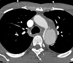 Aortic Dissection Extends to Involve Left Renal Artery and Kidney - CTisus CT Scan