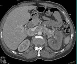 Renal Cell Carcinoma (RCC) Invades Renal Vein and IVC - CTisus CT Scan