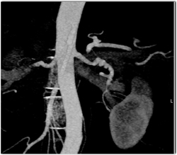 Fibromuscular Dysplasia (FMD) Bilaterally - CTisus CT Scan