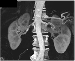 Fibromuscular Dysplasia (FMD) - CTisus CT Scan