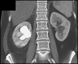 Hydronephrosis With Delayed Function - CTisus CT Scan