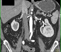 Oncocytoma - CTisus CT Scan