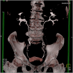 Ectatic Right Ureter - CTisus CT Scan