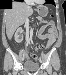 Dilated Right Ureter With Crossing Vessels - CTisus CT Scan