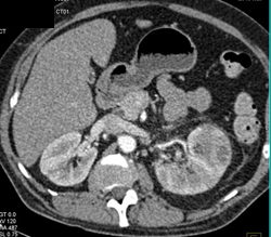 Acute Pyelonephritis - CTisus CT Scan