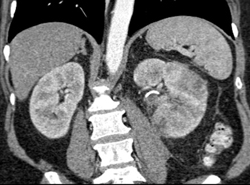 Acute Pyelonephritis - CTisus CT Scan