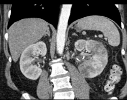 Acute Pyelonephritis - CTisus CT Scan