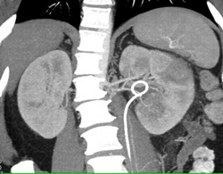 Acute Pyelonephritis - CTisus CT Scan