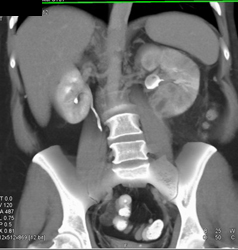 Renal Abscess - CTisus CT Scan