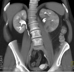 Renal Abscess - CTisus CT Scan