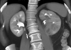 Renal Abscess - CTisus CT Scan