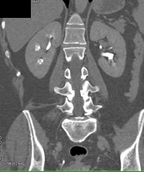 Medullary Enhancement Right Kidney - CTisus CT Scan