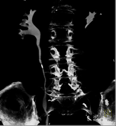 Stone in Ureter - CTisus CT Scan